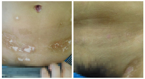 【醫德高尚暖人心，醫術精湛傳四方】白癜風康復患者送來感謝錦旗