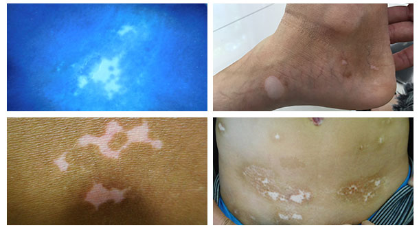 【醫德高尚暖人心，醫術精湛傳四方】白癜風康復患者送來感謝錦旗