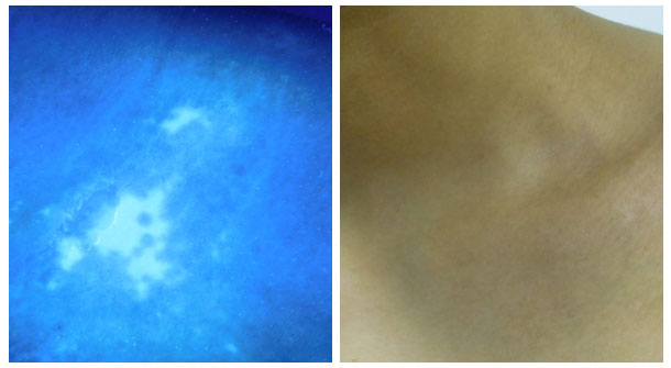 【醫德高尚暖人心，醫術精湛傳四方】白癜風康復患者送來感謝錦旗