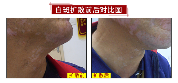 健康中秋·秋季白癜風(fēng)診療惠民活動開啟！