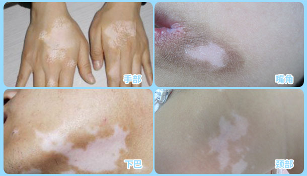 喜迎國慶，金秋送健康北京白癜風醫師大型會診援助活動啟動！