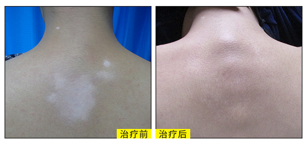 喜迎國慶，金秋送健康北京白癜風醫師大型會診援助活動啟動！