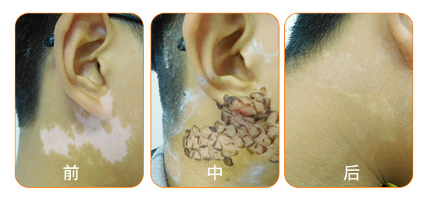 黑色素種植術(shù)前檢查費(fèi)用援助50%!夏病冬治“種”出健康好膚色!