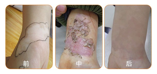 黑色素種植術前檢查費用援助50%!夏病冬治“種”出健康好膚色!