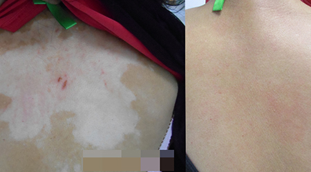 石家莊遠(yuǎn)大 元旦惠民診療援助開啟！看白斑更省錢！