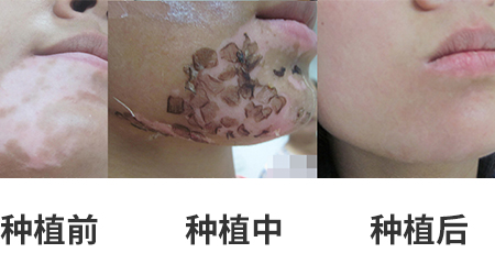 放寒假，祛白斑！7天喚醒黑色素！白斑強化診療進行中！