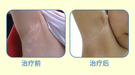 陽(yáng)春三月·抗白復(fù)發(fā)——遠(yuǎn)大白斑抗復(fù)發(fā)活動(dòng)開(kāi)啟！