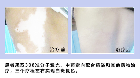 415全國白癜風防治日“遠大白斑診療援助活動開啟！”