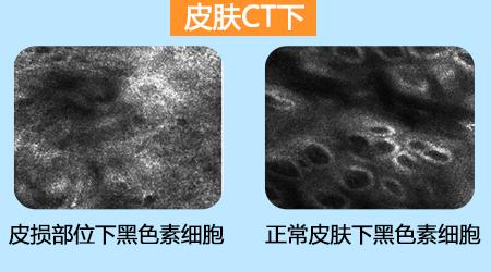 五一關愛全民皮膚健康，到院領取價值2240元白斑診療金!