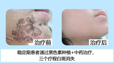 五一關愛全民皮膚健康，到院領取價值2240元白斑診療金!