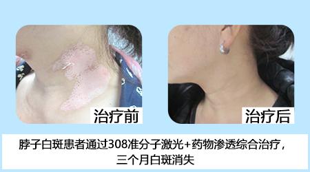 五一關愛全民皮膚健康，到院領取價值2240元白斑診療金!