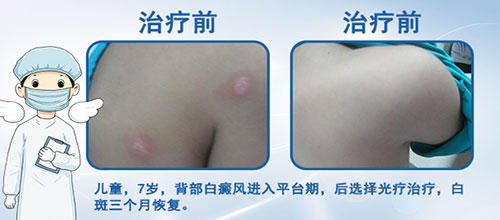 美國極速308nm準分子激光治療系統成功落戶!患者到院可享免費治療一次!