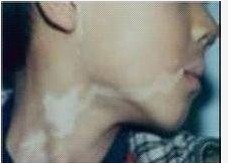 白癜風患兒的飲食上要注意些什么呢