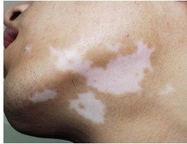 怎么預防白癜風復發效果好?