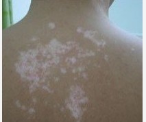 怎么做可以降低白癜風的復發率?