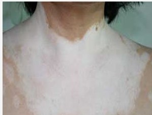 泛發(fā)型白癜風應該怎么預防?