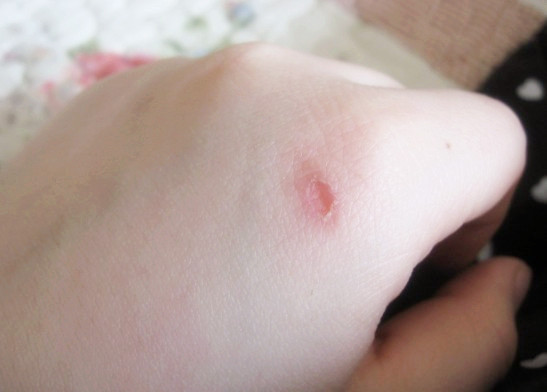 皮膚受傷時應怎樣預防白癜風?