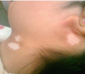 脖子上有白癜風怎么護理