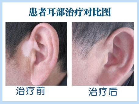 張家口擴(kuò)散的白癜風(fēng)能治嗎