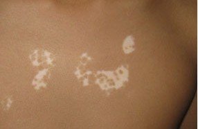 身上有白斑怎么看是不是白癜風呢?