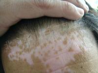 邯鄲成安縣如何對成人白癜風(fēng)進(jìn)行診斷和鑒別?