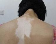 白癜風(fēng)早期如何進(jìn)行自我診斷?