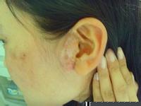 邯鄲白癜風(fēng)和白斑病一樣嗎?