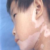 如何判斷身上的白斑是不是白癜風?