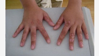 手被貓抓傷后留下的白痕是白癜風嗎?