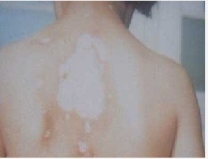 背上長(zhǎng)一小塊白斑怎么判斷是不是白癜風(fēng)?