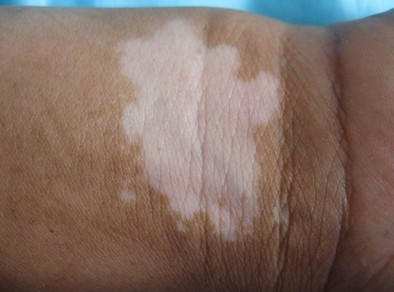 如何通過簡單診斷判斷白斑是不是白癜風?