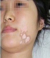 診斷女性白癜風(fēng)有哪些方法?