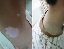 脖子上的白斑是不是白癜風如何判斷