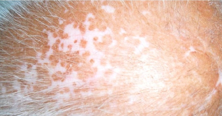 頭上幾根頭發白了皮膚也白是白癜風嗎