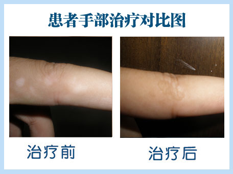 胳膊上有個白點能是白癜風嗎