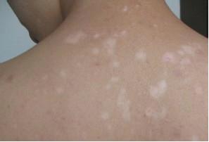 白癜風(fēng)患者出現(xiàn)初期癥狀后要經(jīng)過(guò)哪些檢查