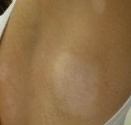 怎么判斷皮膚上的白斑是不是白癜風(fēng)