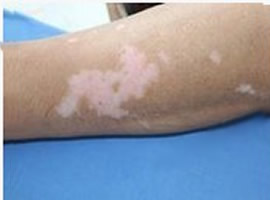 白癜風(fēng)白斑的診斷方法都有什么