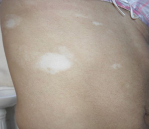 身上出現了白斑不知是不是白癜風