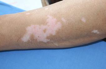 胳膊有小白塊怎么回事