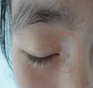 鼻子旁邊有幾個(gè)小白斑是白癜風(fēng)嗎