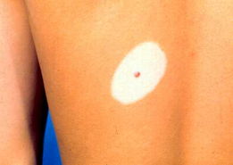 背后出來白色的斑是怎么回事