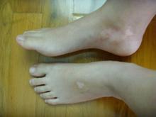 白癜風在早期如何診斷