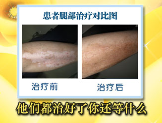 鑒別白斑是不是白癜風的方式