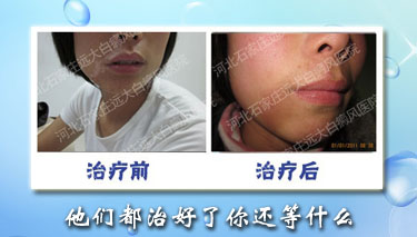 我臉上長(zhǎng)了一些小白點(diǎn)是什么情況