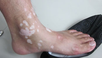 治療白癜風(fēng)之前要去醫(yī)院檢查什么項(xiàng)目