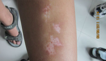 大腿外側有條淡白色的痕跡是白癜風嗎