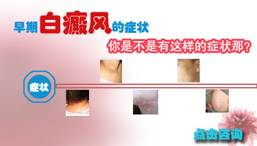 用伍德燈檢查能確診白癜風嗎