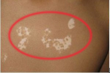 診斷白斑是否是白癜風的方式是什么