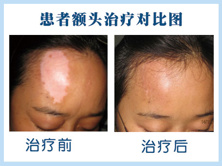 臉上和身上有好幾塊白色是白癜風(fēng)嗎